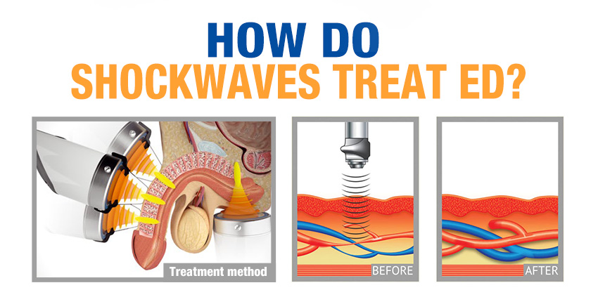 Shock Wave Erectile Dysfunction Machine theory Shock Wave Erectile Dysfunction Machine theory